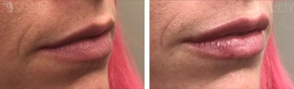 Before and after images demonstrating the lip enhancement effects of a Juvederm filler service.