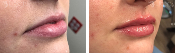 Before and after photos showcasing the volumizing effect of Juvederm lip fillers.