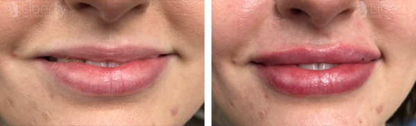 Before and after comparison of a smile enhanced by Juvederm lip filler treatment.