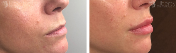 Before and after comparison of Juvederm lip filler treatment showing enhanced lip volume and contour.