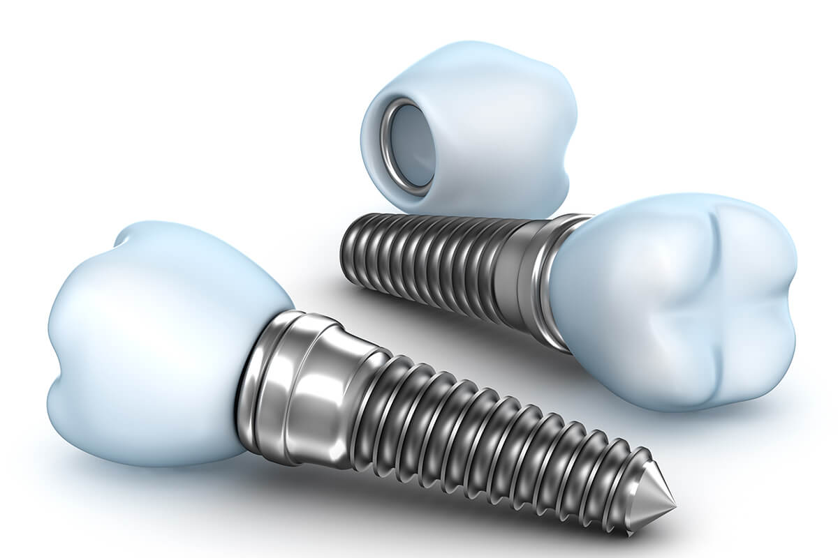 TRUST YOUR DENTAL IMPLANTS TO THE EXPERTISE OF AN ORAL AND MAXILLOFACIAL SURGEON