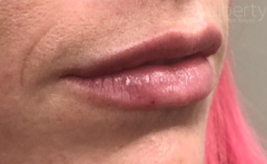 Lips beautifully enhanced and volumized after Juvederm treatment.