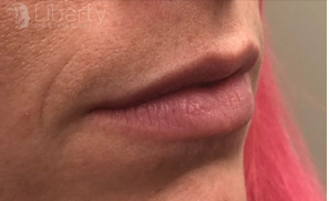Natural lips before Juvederm treatment, displaying the baseline for comparison.