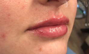 Post-Juvederm Ultra XC treatment showcasing volumized, glossy, and well-defined lips.