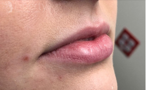 Pre-Juvederm Ultra XC treatment: natural lip profile awaiting volumizing filler.