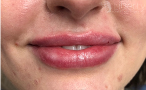 "Plush and enhanced: Lips after Juvederm Ultra XC treatment.