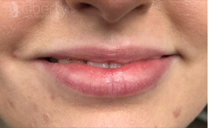 Before Juvederm Ultra XC: lips with natural volume, pre-enhancement.