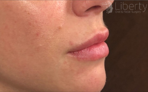 Post-treatment close-up of enhanced, fuller lips following Juvederm filler procedure.