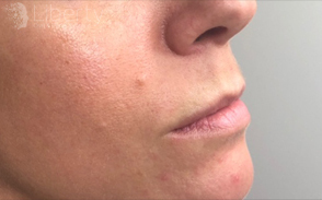 Close-up view of a patient's lips before Juvederm lip filler treatment, highlighting natural contours and baseline volume.