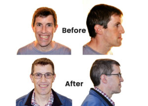 Before and after photos showing facial improvements following corrective jaw surgery at Liberty Oral Surgery.